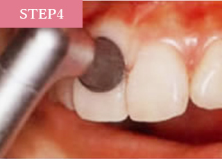 歯肉を傷つけないように、柔らかいラバーカップで歯と歯の境目の汚れを落とします。