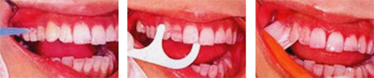 まず、お口の中を隅々まで歯ブラシ、フロス、歯間ブラシなどを使って清掃します。